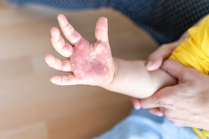 Burns In Children Treatment, Home Remedies And Prevention