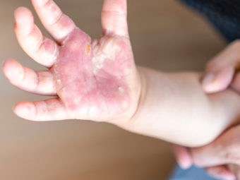 Burns In Children: Treatment And Home Remedies