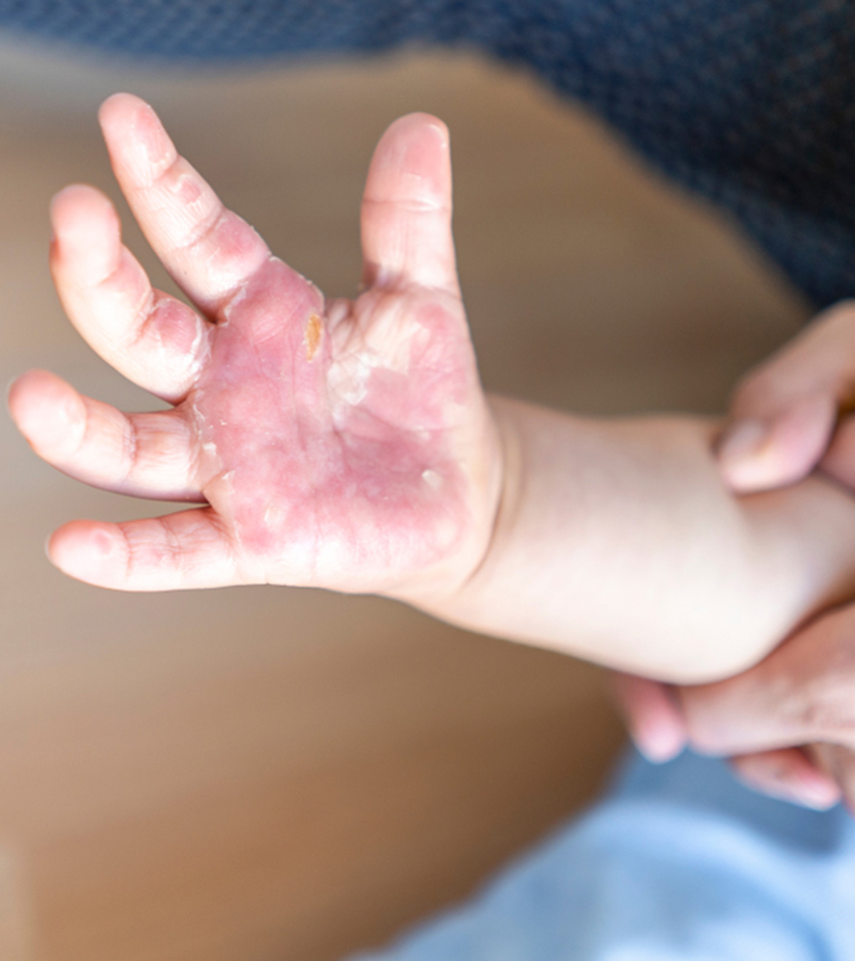 Burns In Children: Treatment And Home Remedies