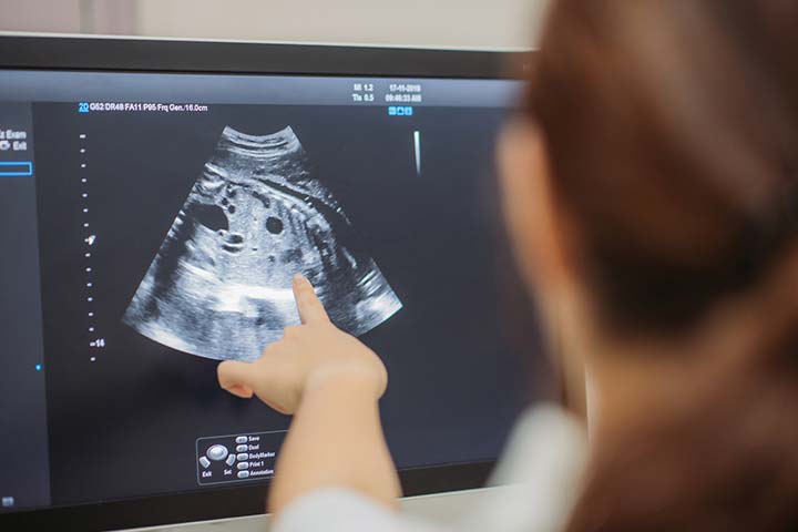 Can The Doppler Ultrasound Miss The Hidden Twins Heartbeat