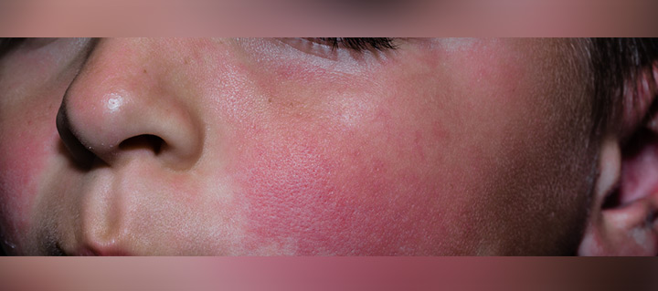 Fifth disease, cause of rashes after fever in toddlers