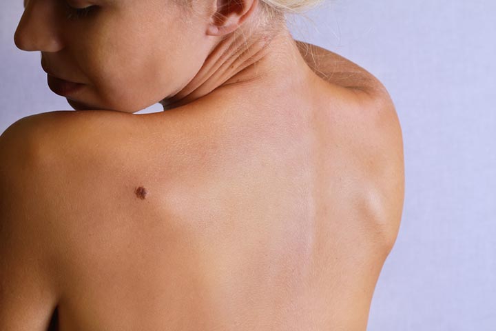 Formation Of Skin Tags