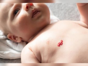Moles In Babies: Types, Causes, And Treatment