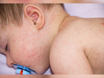 Rashes afterfever In Toddlers Causes And When To Worry