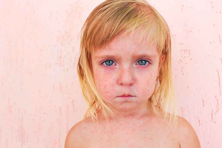 Roseola, cause of rashes after fever in toddlers