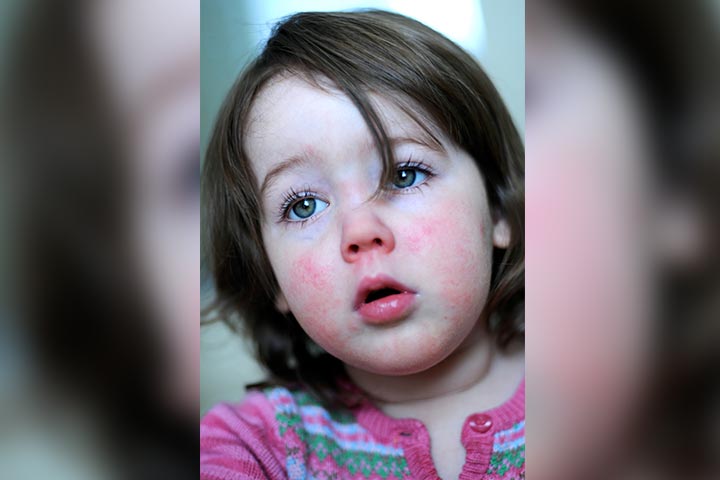 Scarlet Fever In Children Symptoms, Causes, Risks, And Treatment-1
