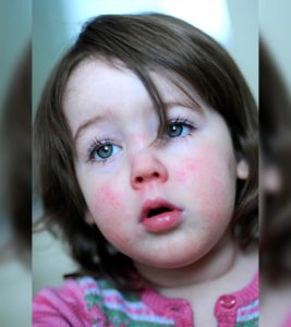 Scarlet Fever In Children: Symptoms, Causes, Risks & Treatment