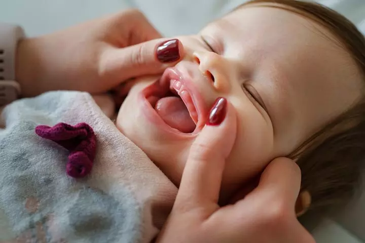 Swollen gums may indicate teething in three-month-olds