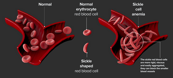Systemic disorders such as sickle cell anemia may delay teething