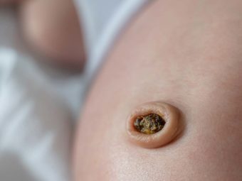 Umbilical Granuloma In Newborns Symptoms, Causes And Treatment