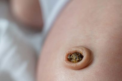 Umbilical Granuloma In Newborns: Symptoms, Causes And Treatment