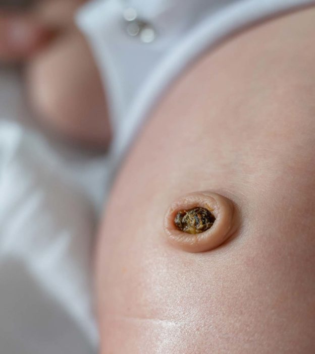 Umbilical Granuloma In Babies: Causes, Treatment, And Care