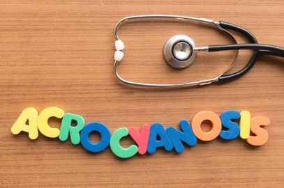 Acrocyanosis In Newborn: Causes, Symptoms, Diagnosis And Treatment