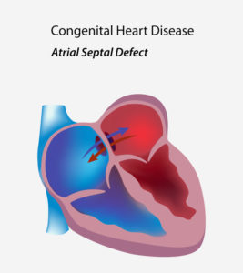 Atrial Septal Defect (ASD) In Babies: Types, Causes And Treatment