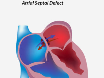 Atrial Septal Defect (ASD) In Babies: Causes And Treatment