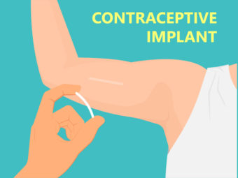 Birth Control Implant: Benefits And Side Effects