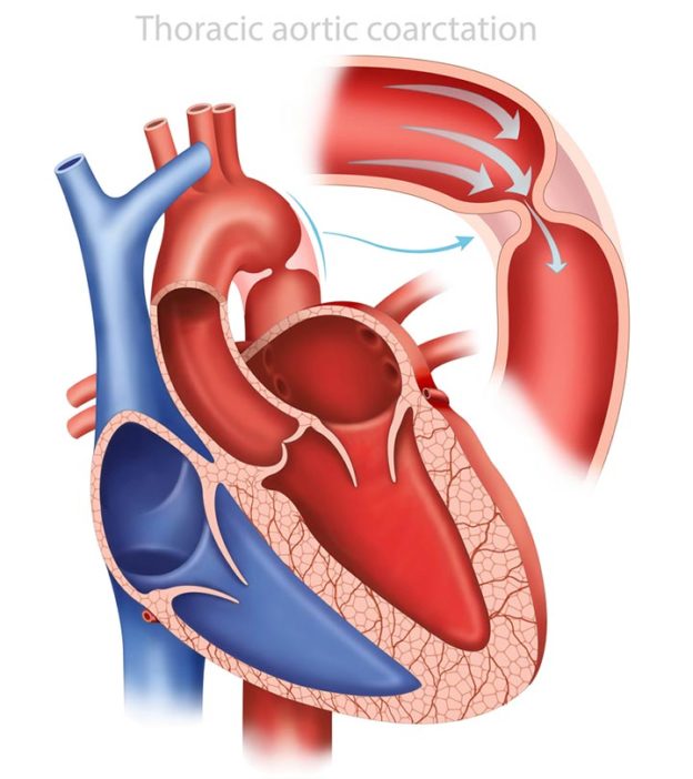 Coarctation Of The Aorta (COA) In Infants: Causes, Symptoms And Treatment