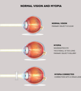 7 Causes Of Myopia In Children, Diagnosis And Treatment