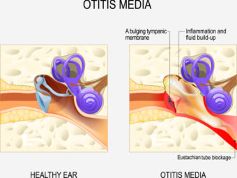 Otitis Media (Middle Ear Infection) In Children: Types, Symptoms, And Treatment