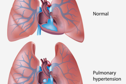 Persistent Pulmonary Hypertension Of The Newborn (PPHN): Causes And Treatment