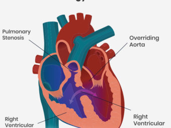 Tetralogy Of Fallot In Babies: What It Is, Symptoms & Treatment