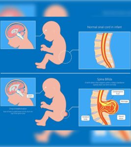 Spina Bifida In Babies: Types, Symptoms, Diagnosis & Treatment