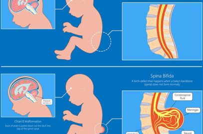 Spina Bifida In Babies: Types, Symptoms, Diagnosis And Treatment