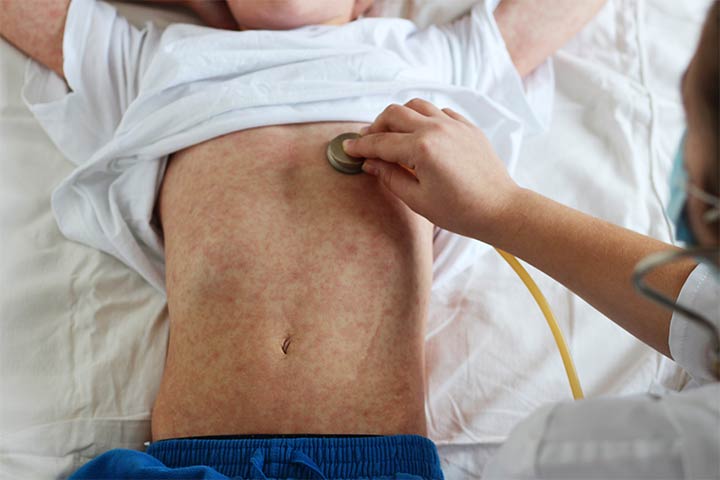 Viral rash in children, measles
