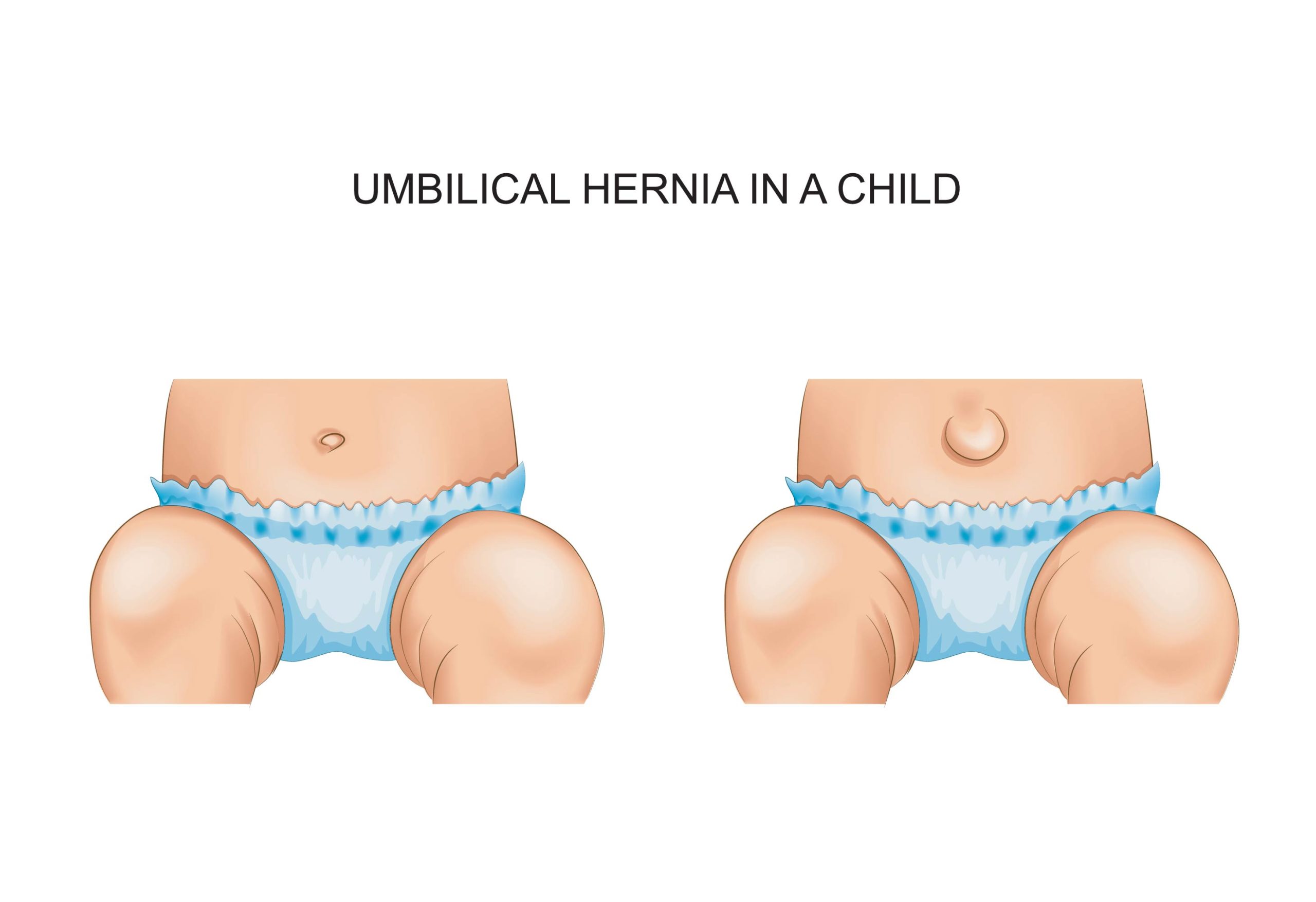 Umbilical hernia in children