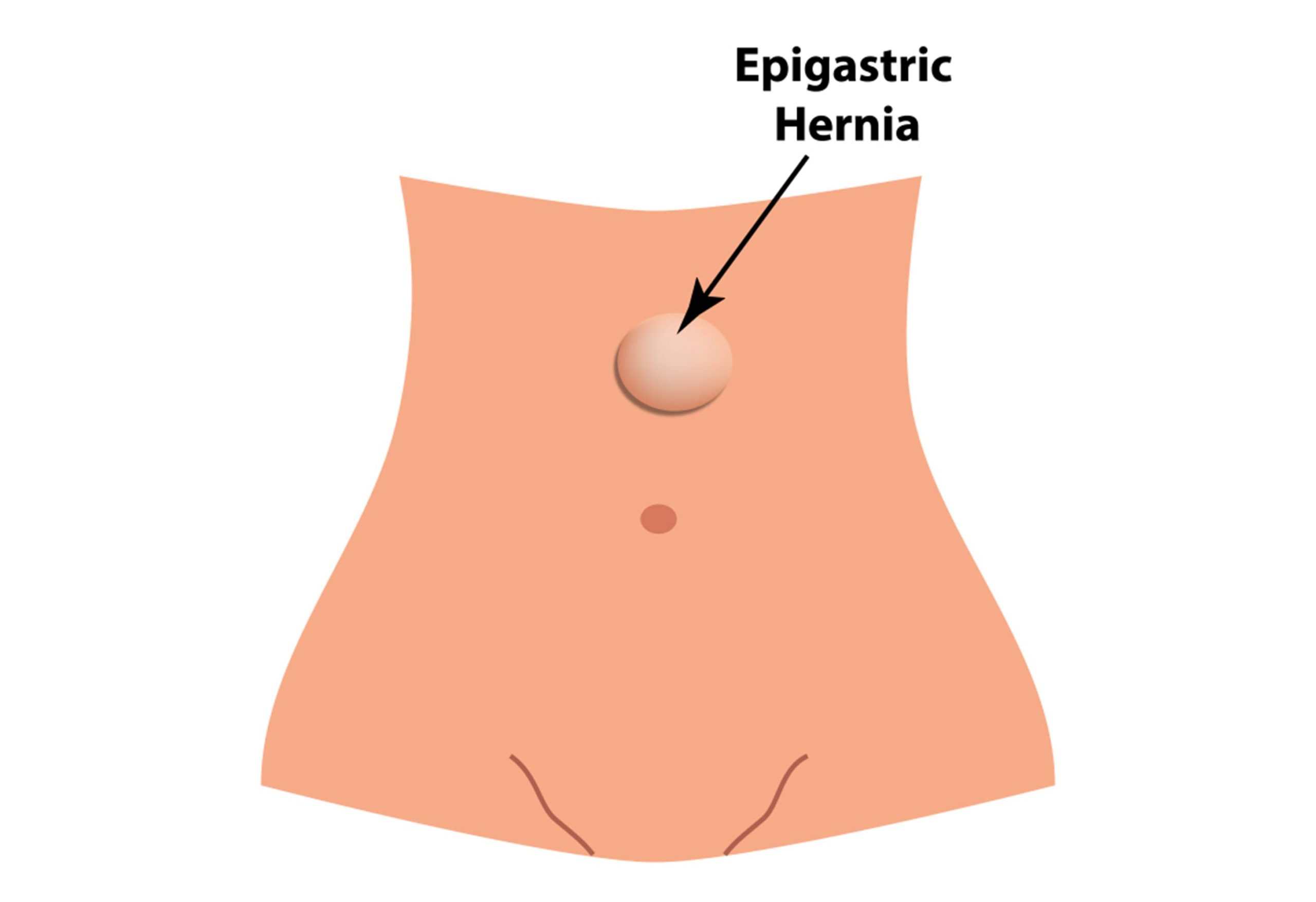 Epigastric hernia in children