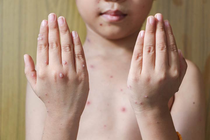 Viral rash in children, chickenpox