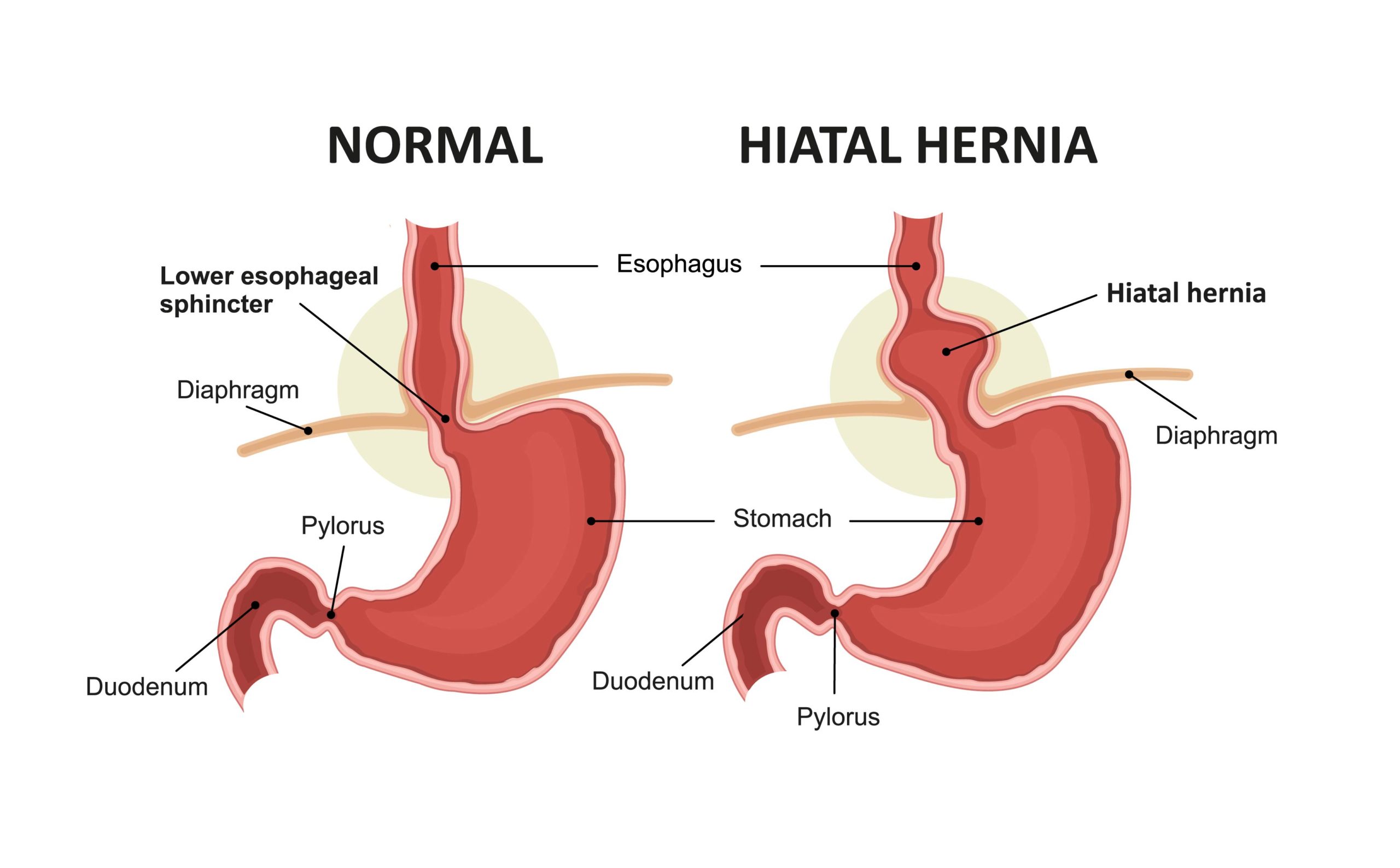 Hiatal hernia in children