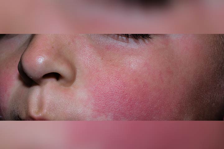 Viral rash in children, fifth disease