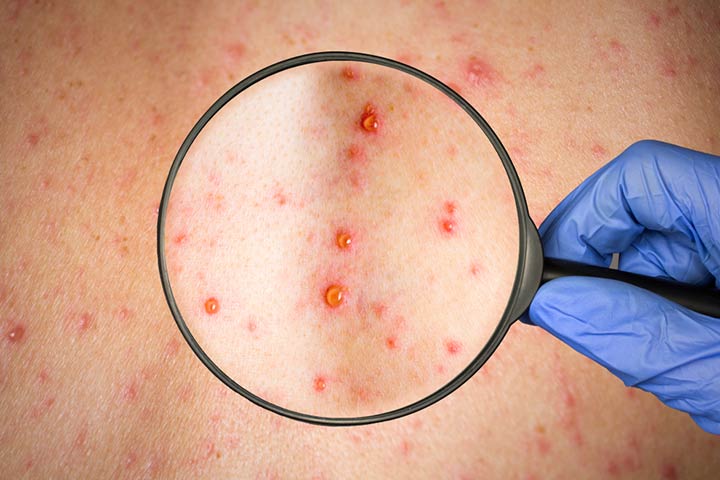 Viral rash in children, rubella