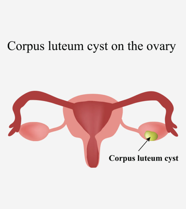 Corpus Luteum Cyst In Pregnancy: Symptoms And Treatment
