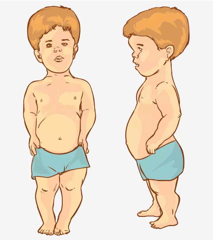 Dwarfism In Children