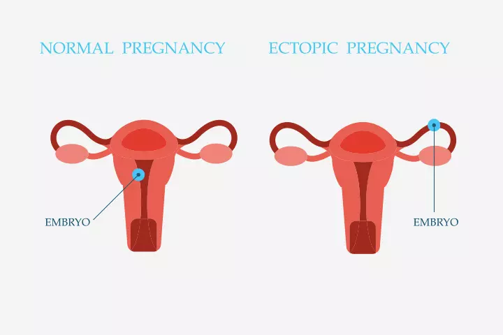 Ectopic pregnancy could cause cysts