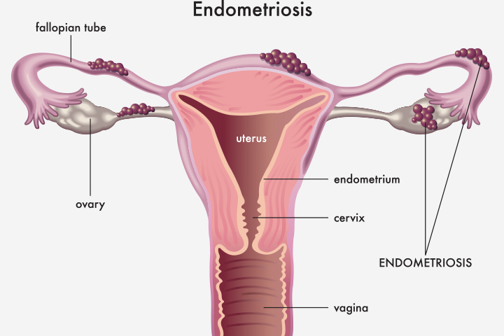 Endometrioid cysts spring from endometriosis
