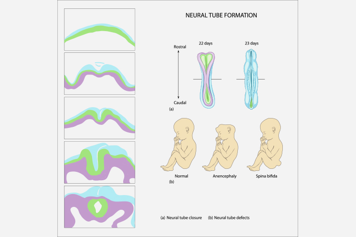 Folate deficiency may cause neural tube defects in the baby