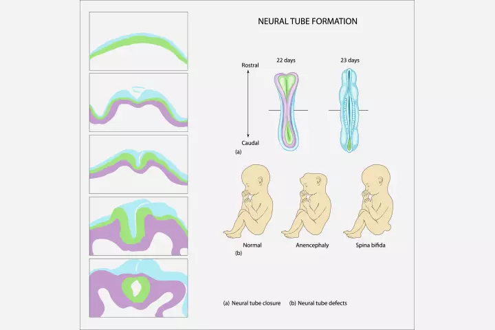 Folate deficiency may cause neural tube defects in the baby