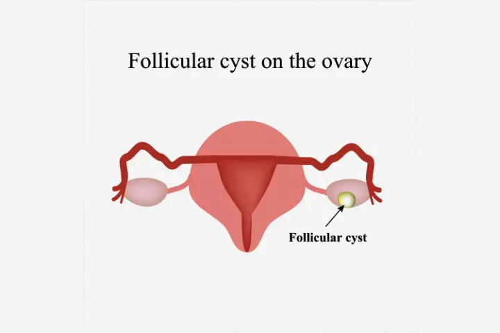 A follicular cyst does not require any treatment