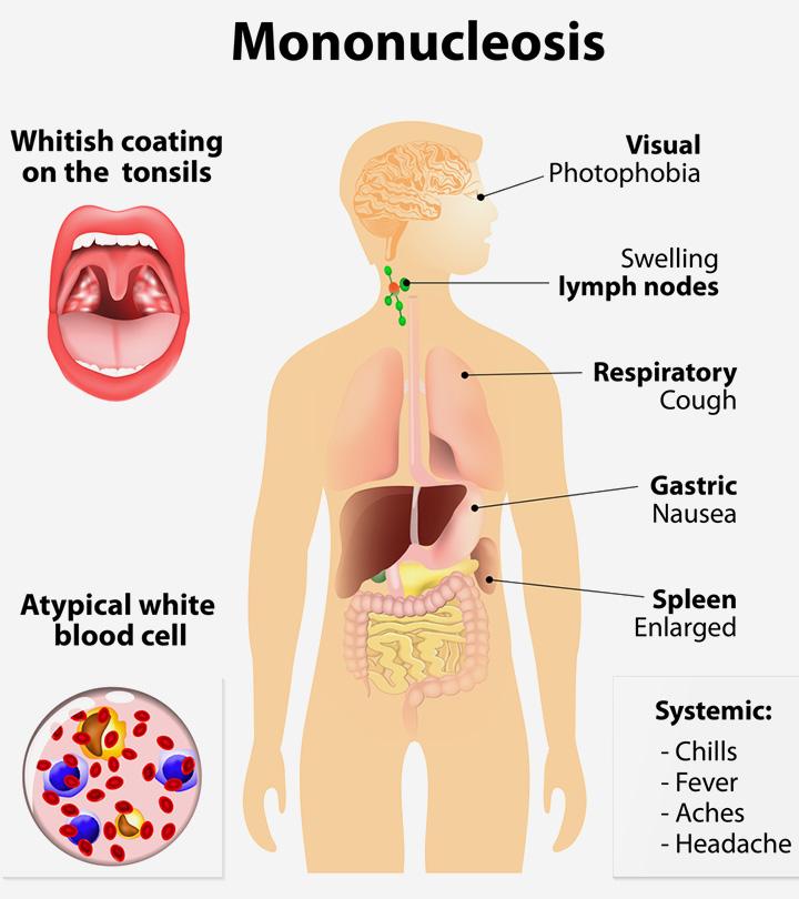 10-signs-and-symptoms-of-mono-mononucleosis-youtube