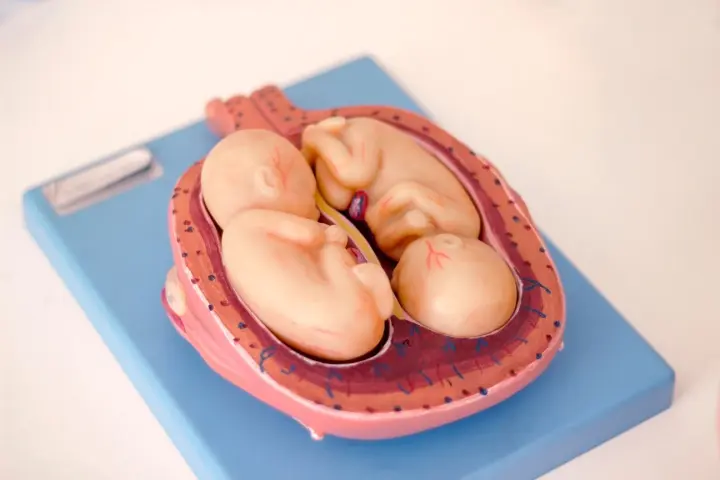 Multiple babies may cause first trimester bleeding