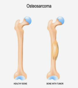 Osteosarcoma In Children: Types, Causes, Symptoms, And Treatment