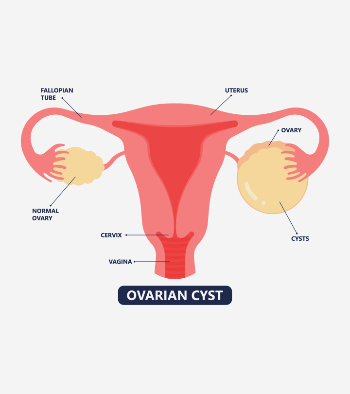 Pregnant With Ovarian Cysts: Types, Causes And Treatment