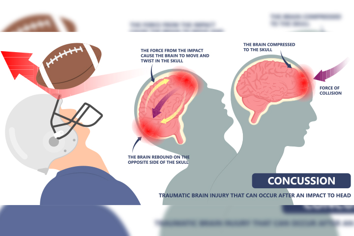 Read this post to learn more about the causes of concussions 
