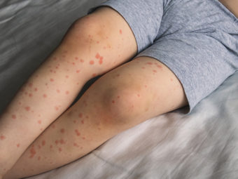 Roseola In Children: Symptoms, Causes, Treatment & Prevention