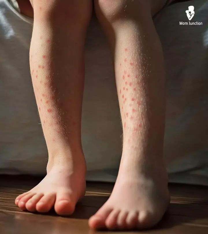 A Kid Suffering From Roseola