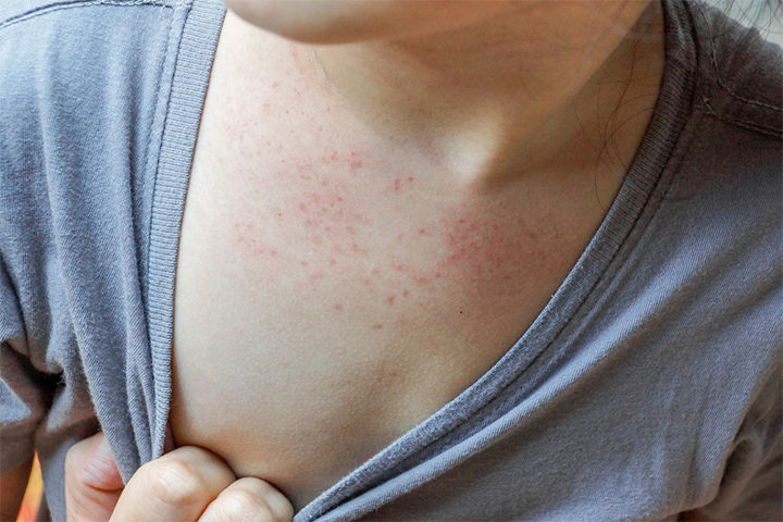 Skin rash after a fever is a symptom of roseola in children