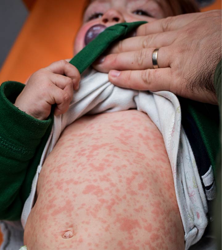 Viral Rash In Children: Types, Pictures, Treatment And Prevention